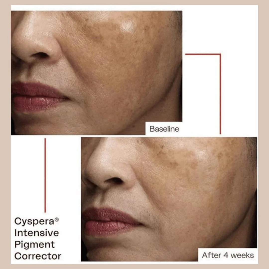 Cyspera® Intensive Pigment Corrector Original Formula 5% Cysteamine 1.75 fl oz - Image 4