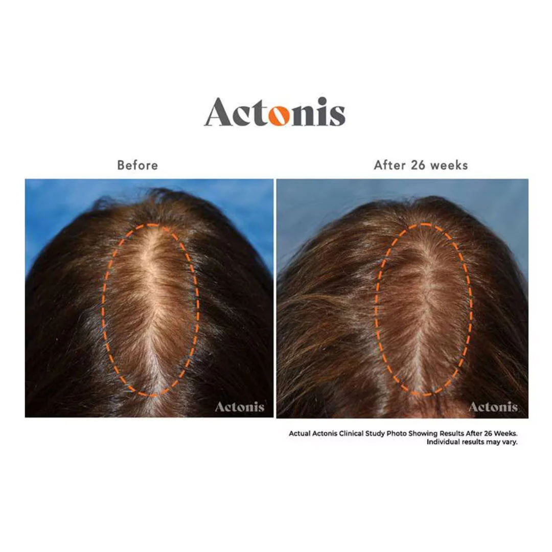 HairMax® Actonis 18 Dual Action LaserComb - Image 5