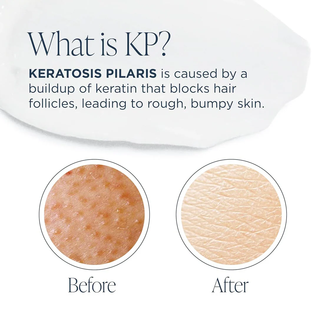 Glytone® KP Kit - Image 3