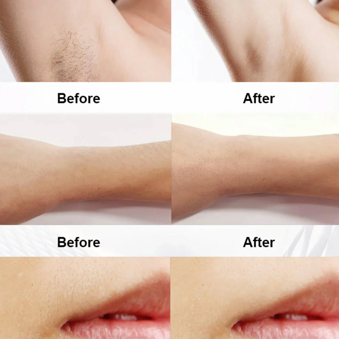LuminaNRG® Numiere IPL Hair Removal with Ice Cooling - Image 6