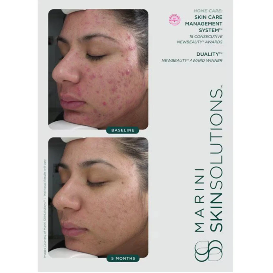Marini SkinSolutions® Duality Acne Treatment Cream & Anti-Aging Complex 1.0 fl oz - Image 4