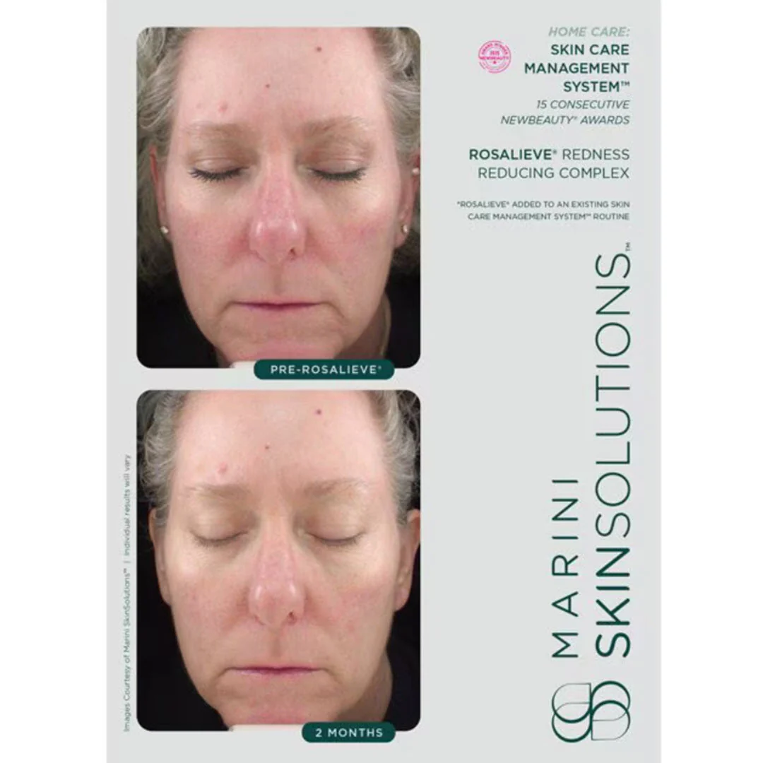 Marini SkinSolutions® RosaLieve® Redness Reducing Complex 1 fl oz - Image 4