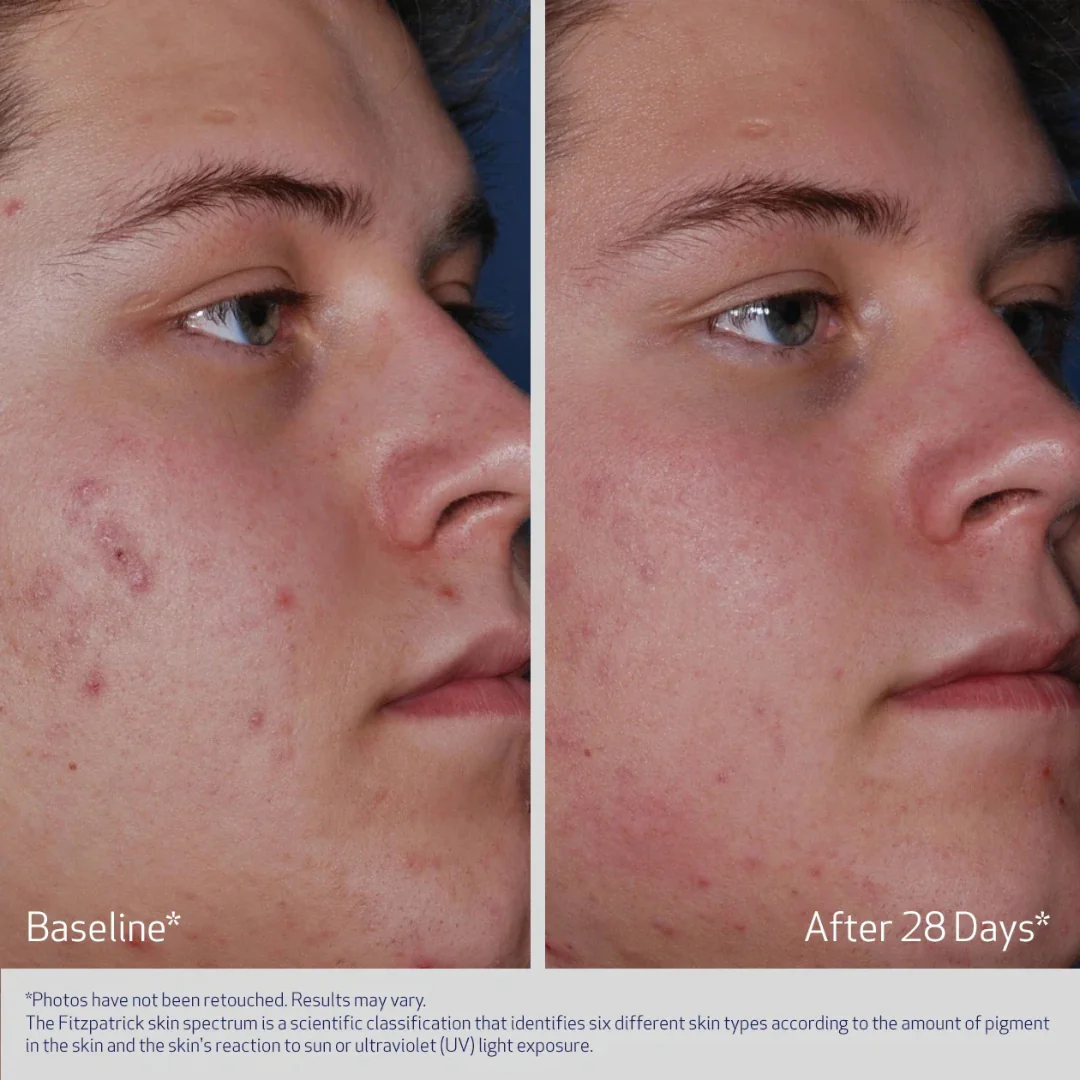 OBAGI® CLENZIDERM M.D. ACNE THERAPEUTIC SYSTEM - Image 5