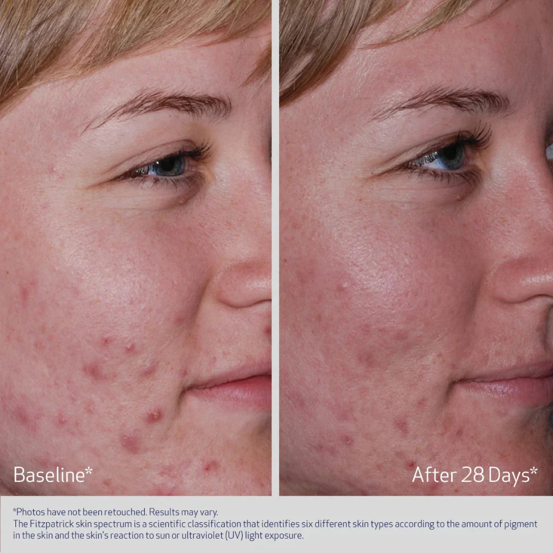 OBAGI® CLENZIDERM M.D. ACNE THERAPEUTIC SYSTEM - Image 6