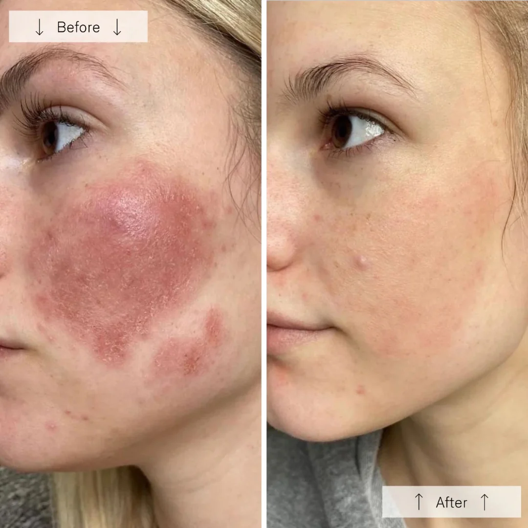 Omnilux® Contour Face - Image 12