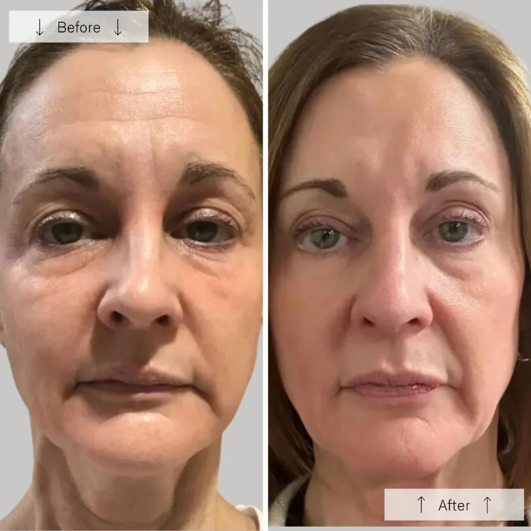 Omnilux® Contour Face - Image 13